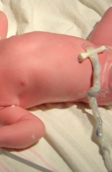 A baby's torso with white umbilical cord still attached and clamp visible near belly button