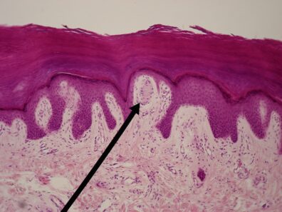 Micrograph of skin with upper layers stained magenta and an arrow pointing to a round Meissner's corpuscle