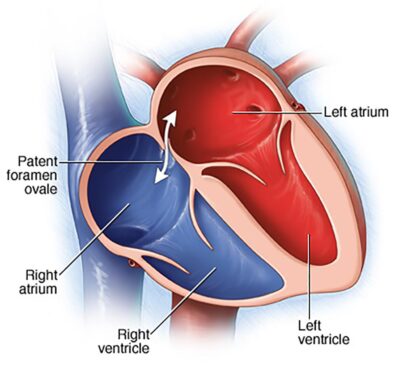 labeled diagram shows a patent foramen ovale opening between the blue right chambers and red left chambers of the human heart