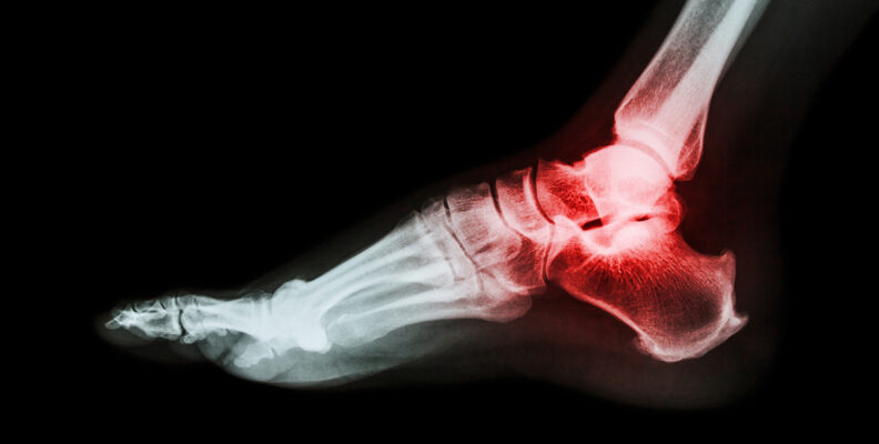 X-ray image of arthritic ankle with inflammation shown in red