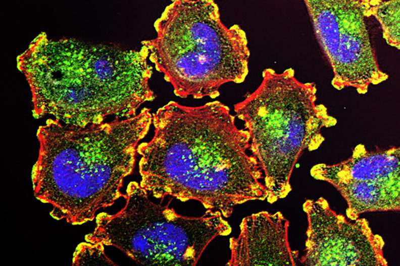 Metastatic melanoma cells under microscope.