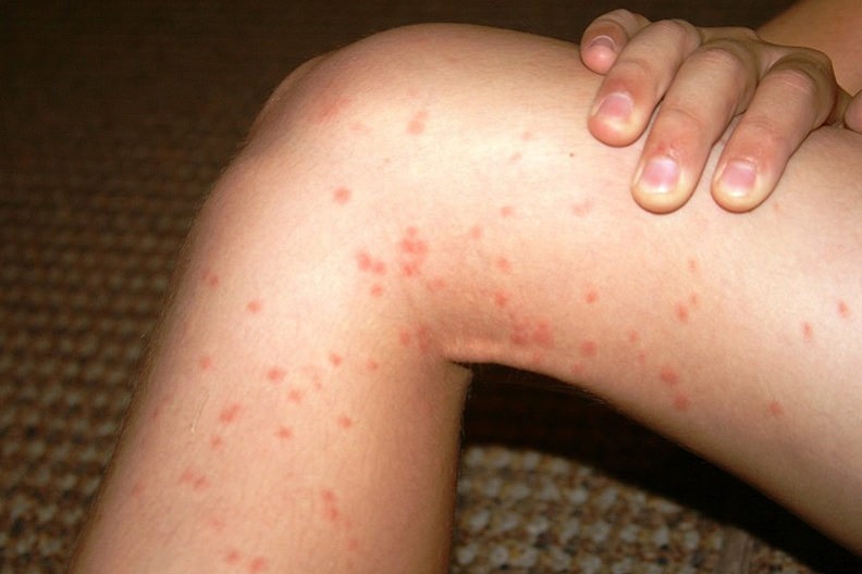 Red bumps (swimmer's itch) all over a leg.