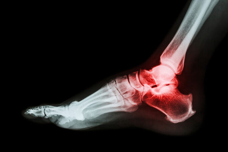 X-ray image of a foot.